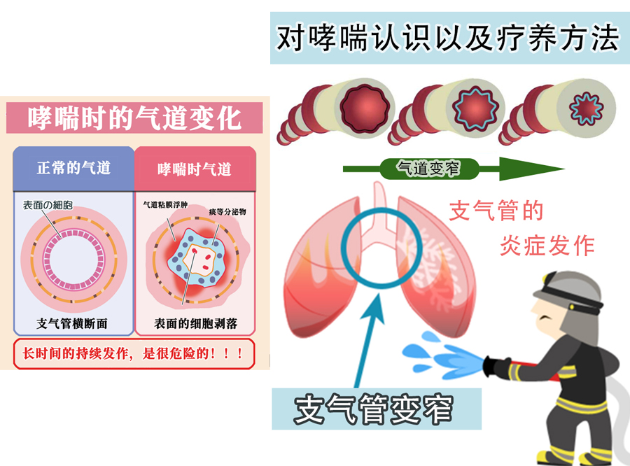 哮喘（支气管哮喘）是由呼吸道炎症引起的 预防哮喘恶化的 4 件事 2025年健康讲座
